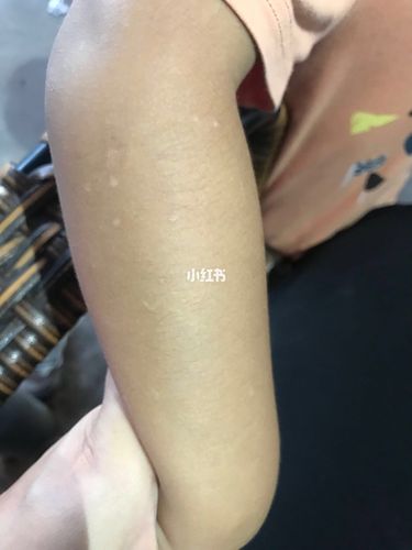 宝宝手上长得小白点是什么?有人知道吗?_宝宝健康_母婴_育儿经验