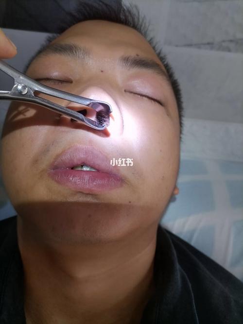 鼻息肉_医疗健康_医疗健康其他