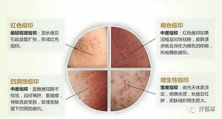 第一种痘印:痘疤