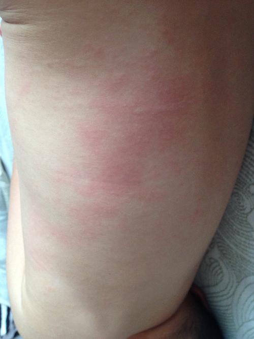 2岁宝宝发烧三天,吃退烧药感冒药消炎药后退烧,退烧后起了图片上所