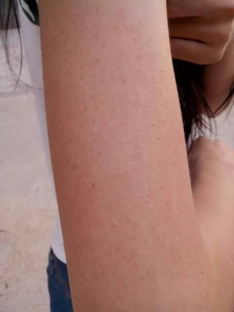 请问这是毛囊炎么?