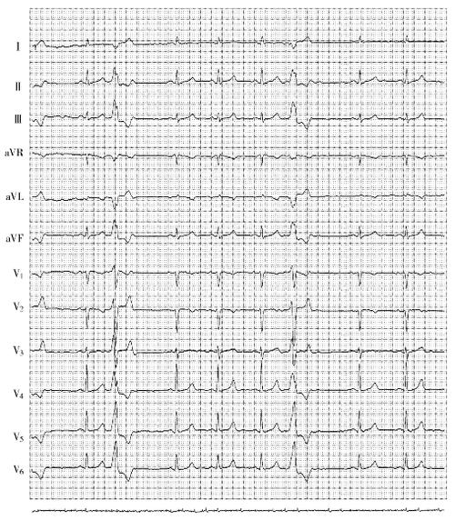 室性期前收缩_实习医师心电图