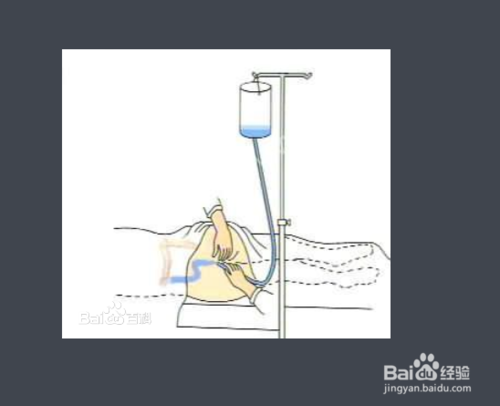 中药灌肠的有效方法