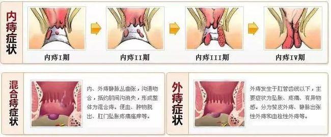 痔核伴有明显水肿,疼痛剧烈.内痔可伴发绞窄,嵌顿.可伴出血.