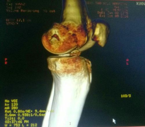 股骨内侧髁骨折,胫骨平台骨折,髁间嵴撕脱骨折.