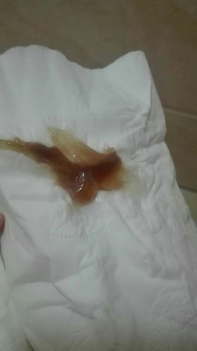 排卵期肚子有点刺痛不是太明显然后有褐色鼻涕一样的分泌物怎么