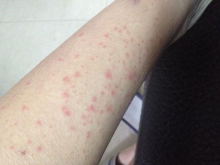 一个晚上的时间脚上起来好多的疹子-_-#不痛不痒的没感觉,看着自己