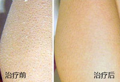 轻度鱼鳞病症状有哪些