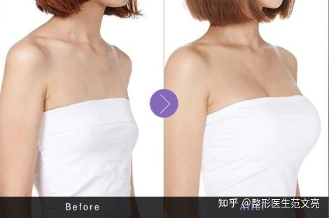 假体隆胸后注意事项有哪些