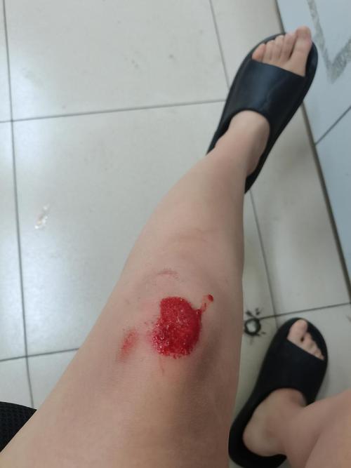 22上午骑电车磕路上了……左腿膝盖和右胳膊,中面积破皮出血……有点