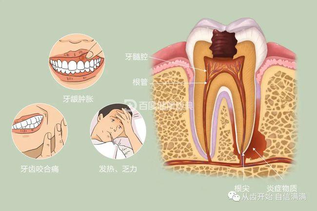 根尖周炎临床症状