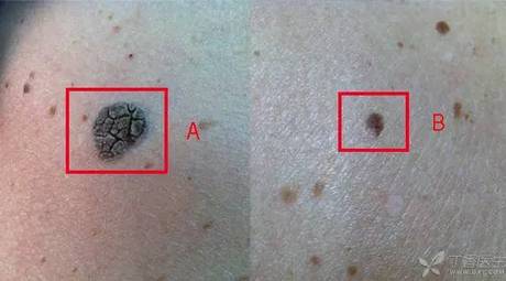 总的来说,长这「疣」的,男性比女性多.