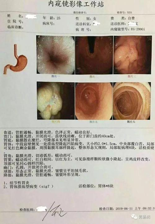 25岁姑娘查出胃癌!这些情况,胃肠镜检查必须要做