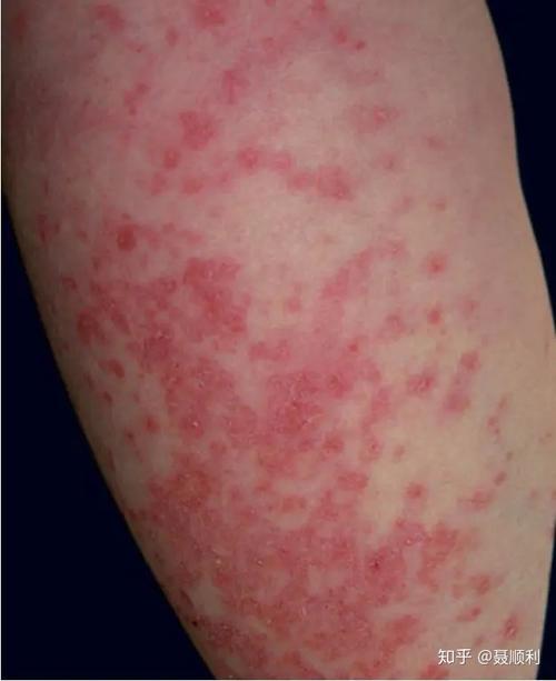 急性皮肤型红斑狼疮