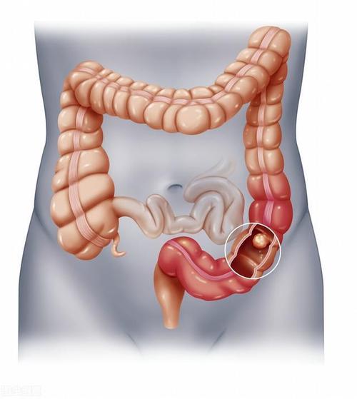 慢性直肠炎病因病理,诊断与治疗