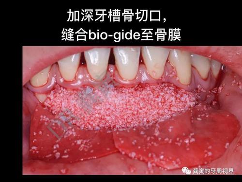 填塞骨粉后尝试封闭效果.