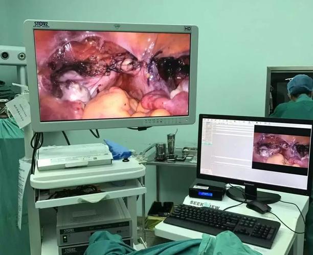 临床一线微创取代开刀四个钥匙孔开展腹腔镜子宫全切术