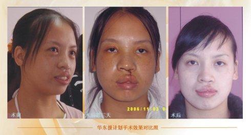 其它案例(唇裂二期修复对比照)