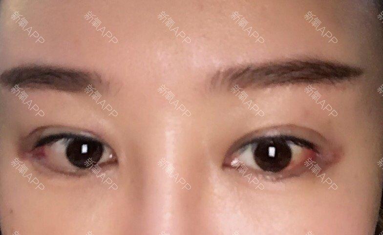 新氧- 炽天使_917568 | 术后当自强 | 深圳同城 | 外眼角下拉 | 眼部