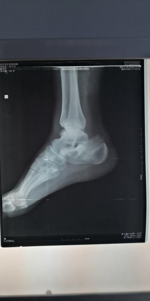 跟骨骨折大l切口内固定