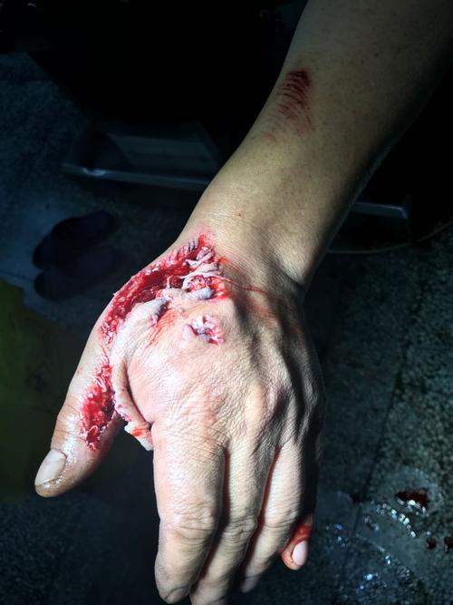 左手背皮肤软组织剥脱伤