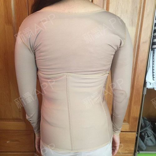 背部和肩膀吸脂 (第1页)