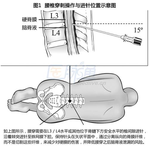 这份指南  由于坐姿与更严重的头痛相关,因此建议在侧卧位下执行腰穿