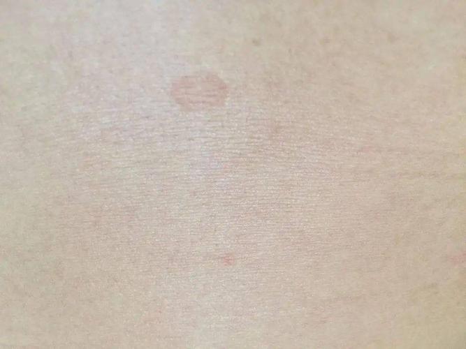 汗斑处皮肤可以恢复汗斑治愈后常会在皮肤上留下白色的斑疹,它是一种