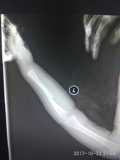 一岁儿童尺桡骨骨折,急诊手法正骨