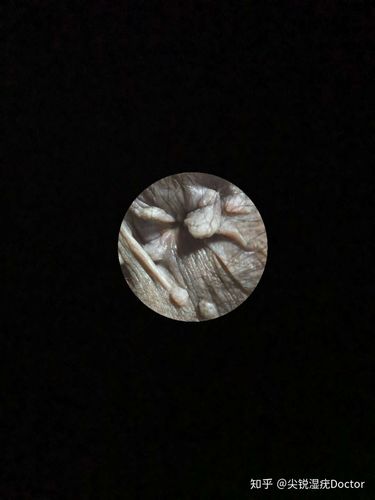 尖锐湿疣肛周疣体症状图片