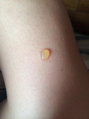 早上起来发现小腿上长了个水泡,不痛不痒