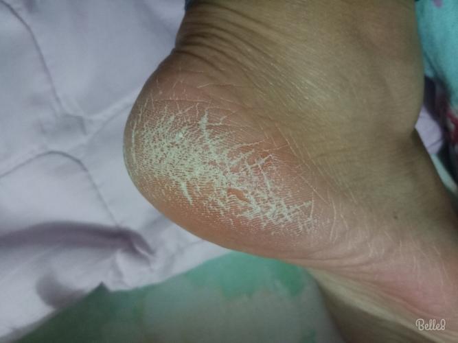 脚后跟干裂用什么润肤乳能缓解呢?