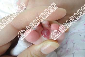 小儿足部的草莓状血管瘤怎么治疗好