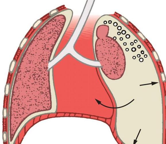 气胸是怎么回事