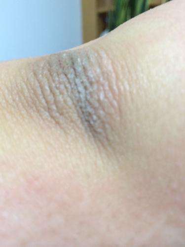 胳膊肘上皮肤异常见照片,没什么疼痒感觉,只是很粗糙.