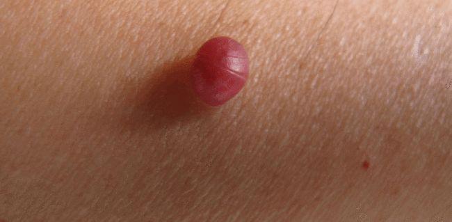 樱桃状血管瘤好发于30岁以上中老年人无传染性病因尚不明确