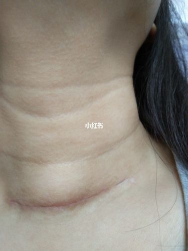 甲状腺术后第36天,脖子还是有点鼓包,说话多了嗓子容易疼,声音有点哑