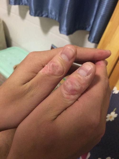 大拇指关节脱皮发硬还痒