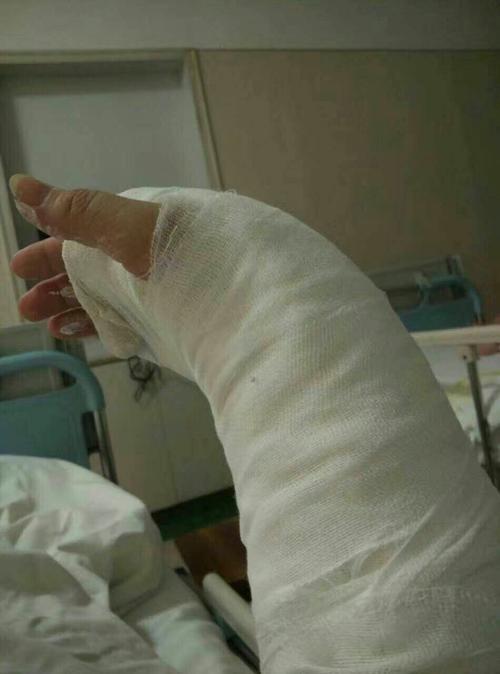 打了石膏的右手被取笑像猪蹄
