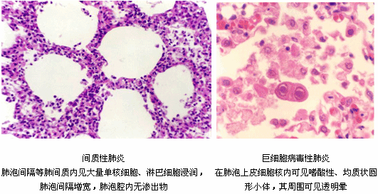 病毒性肺炎的简笔画