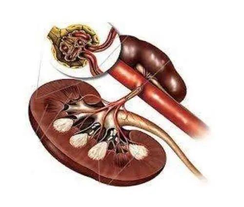 得了慢性肾衰竭4期能活多久?