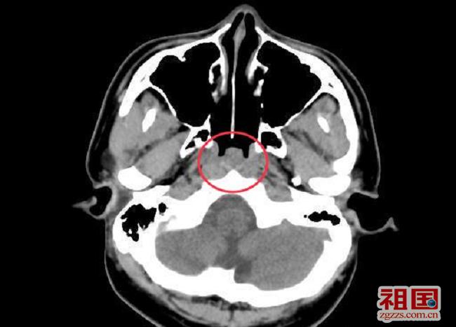 江苏省第二中医院:腺样体肥大该不该手术