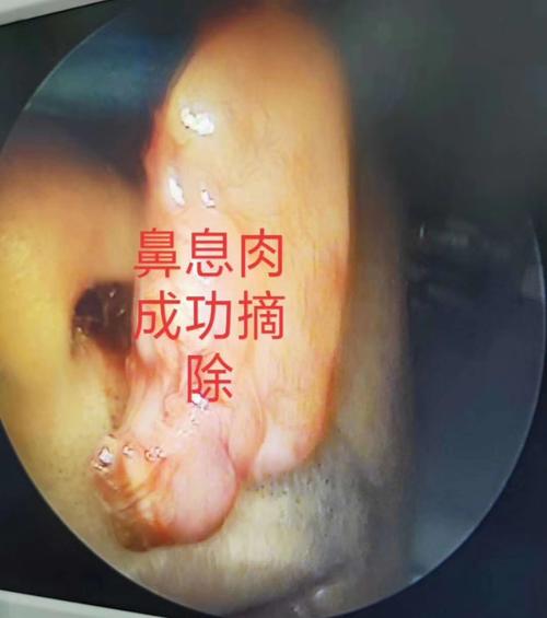 关于鼻息肉,你了解多少?