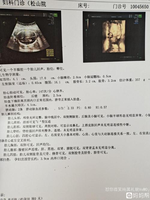 22周四维彩超出来了,宝妈们能出来男女宝