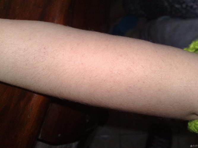 4岁患儿前臂针尖样皮疹