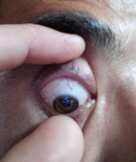 问:眼睛里红血丝越来越长是怎么啦?