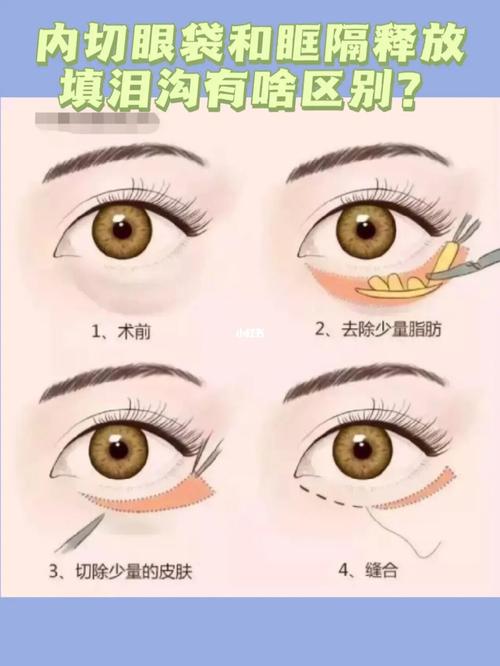 内切眼袋和眶隔释放填泪沟有啥区别?_眼袋_泪沟_眼部