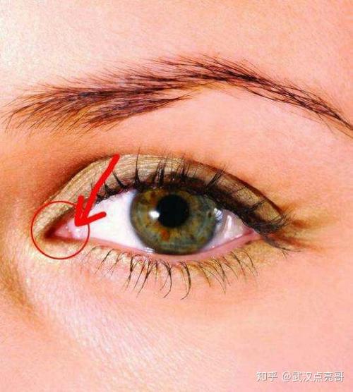 你说的应该是"泪阜",正常的泪阜在眼睛靠鼻侧凸起来,一个蔷薇(粉红)