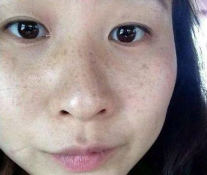 女人怕长斑,斑却怕它,唯诺雅建议用它,黄褐斑自动消失