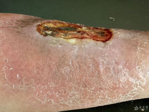 2016年皮肤版有奖病例猜答(10)答案:坏疽性脓皮病